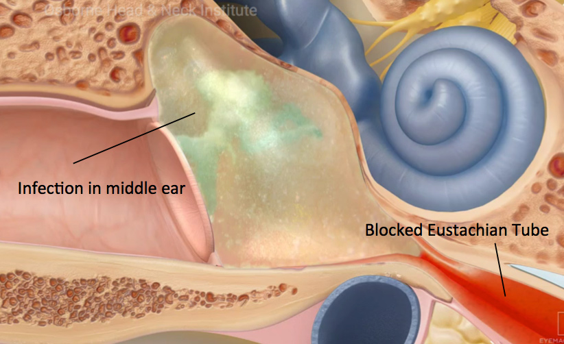 eustachian-tube-treatment-los-angeles-ent-specialists