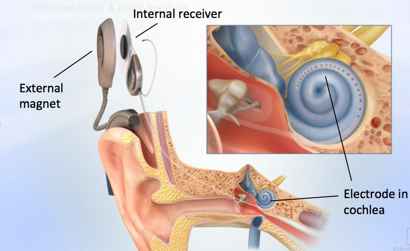 cochlear-implant-device-los-angeles-ca