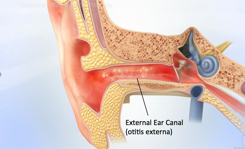 ear-infection-treatment-los-angeles