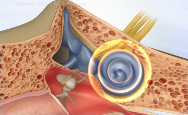 Hearing Loss Treatment Los Angeles, CA